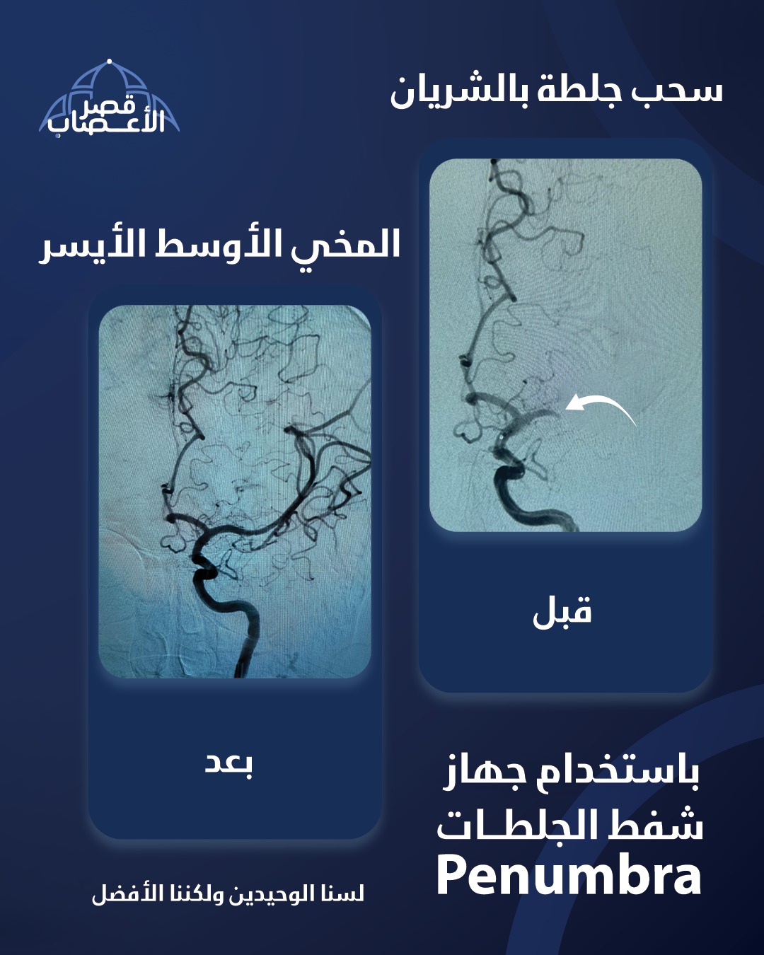 سحب جلطة بالشريان المخي الاوسط الايسر باستخدام جهاز شفط الجلطات